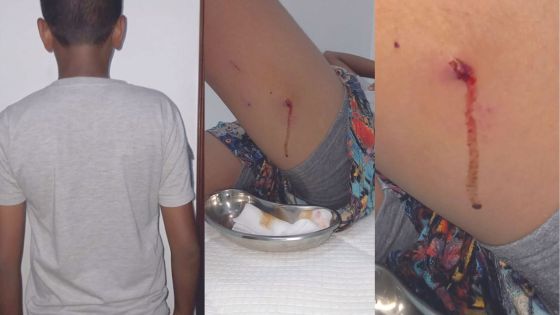 À Belle-Rose : un ado de 14 ans blessé après avoir été attaqué par un chien 