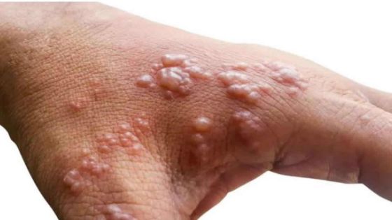 Variole du singe : une maladie rare dont on guérit en général spontanément