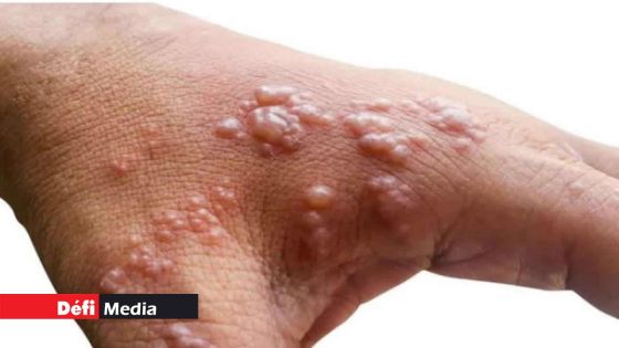 Variole du singe : les procédures enclenchées pour l’obtention de 1000 vaccins 