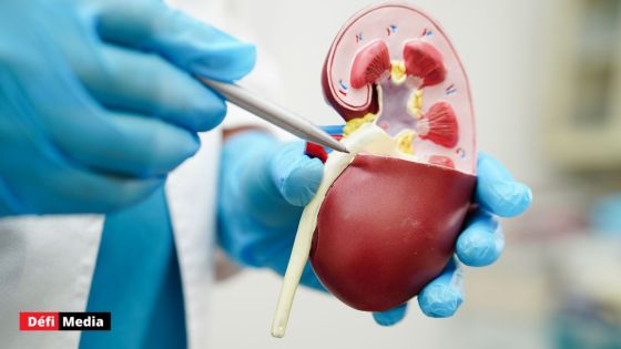 Une greffe de vessie réalisée avec succès aux Etats-Unis, une première mondiale