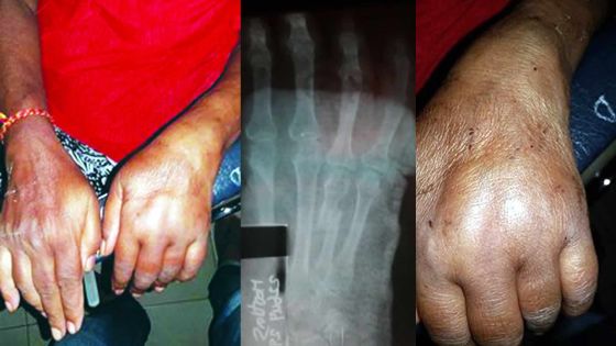 Négligence médicale alléguée: Hospitalisée pour une fracture elle contracte un problème cardiaque