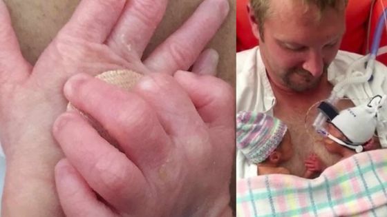 Émouvante histoire de jumeaux prématurés et inséparables