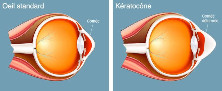 Greffe de la cornée à Apollo Bramwell: Shamima recouvre la vue après 17 ans