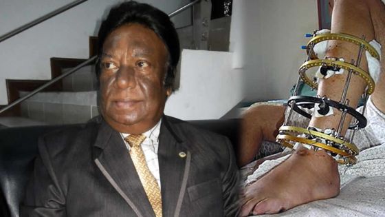 Découverte du Dr Indraduth Chunnoo: une armature métallique pour traiter les fractures