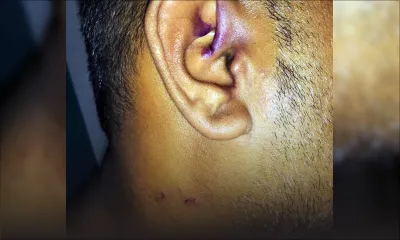 Allégations de brutalité policière - Veenaye : «Akoz enn kontravansyon gagn bate koumsa ?»