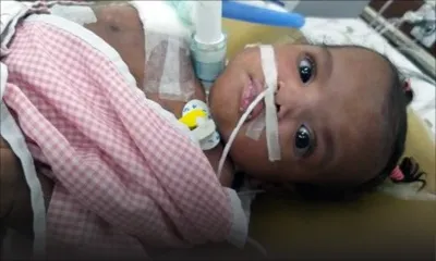 Opération réussie de Cléanne : une première mondiale pour l’équipe médicale de Narayana Health