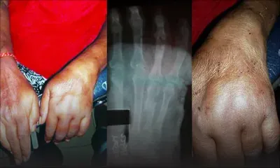 Négligence médicale alléguée: Hospitalisée pour une fracture elle contracte un problème cardiaque