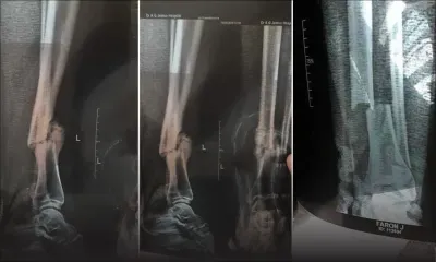 Accident de la route : aucune intervention chirurgicale malgré un tibia fracturé depuis neuf mois