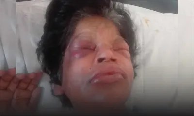 Elle voulait cueillir des brèdes : elle est défigurée par une attaque d’abeilles