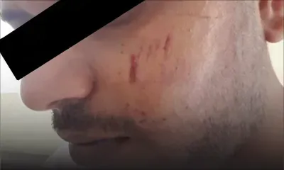 Mordu à la joue par son frère