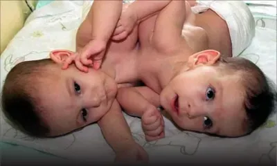 Siamois - Cas à l’étranger : ces opérations couronnées de succès