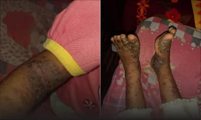 Appel à la solidarité : souffrant du syndrome hyper-IgE, Chloé a besoin de vous