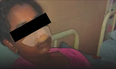 Après une chute à l’école : une fillette contrainte de porter deux incisives temporaires 