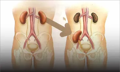 Appel à solidarité : besoin de fonds pour une transplantation des reins