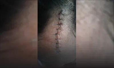 À Port-Louis : un échafaudage s’effondre des clients gravement blessés