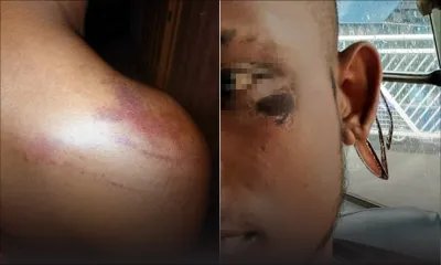 À l’arrière du Plaza : un ado  risque la surdité après s’être fait agresser par deux malfrats