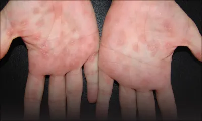 Maladie sexuellement transmissible : la syphilis touche de plus en plus de jeunes