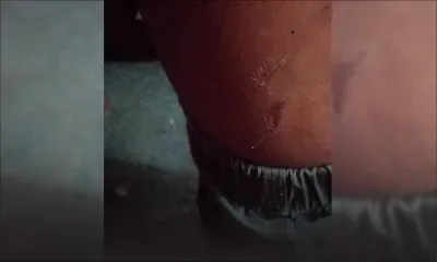 À Tranquebar : un enfant de cinq ans mordu par un chien 