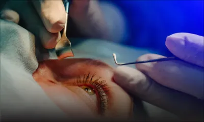 Cataracte : environ 7 000 opérations effectuées en 2022