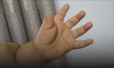 À l’hôpital du Nord - Doigt sectionné : le père d’un bébé de 16 mois brise à son tour le silence