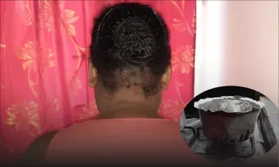 Violence domestique - Bénédicte :  «Line pren deksi de lo bouilante pu verse lor moi»