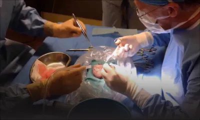 Transplantations rénales : des chirurgiens indiens pour les opérations