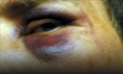 Violence domestique - Rachelle : «Linn batt mwa akoz monn dir li pa fini so kass dan kazino»