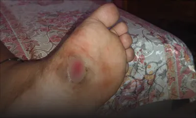 Plainte contre l’hôpital Jeetoo : Yan, 11 ans, a vécu 5 mois avec du caoutchouc dans le pied