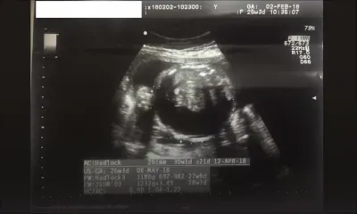 Allégation de négligence médicale : elle perd son bébé un jour après l’accouchement