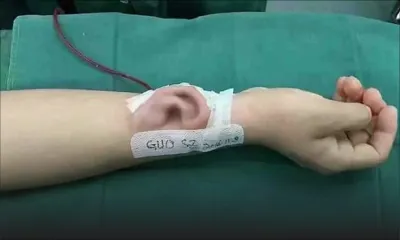 Chine : on lui greffe son oreille sur le bras ; regardez pourquoi