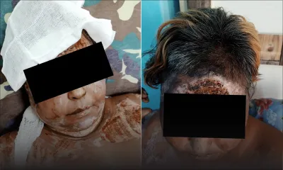 Séquelles d’une attaque au cocktail Molotov : brûlée au troisième degré, Faeza, 41 ans, est totalement démunie