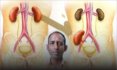 Don d’organe : sans rein, Hemant Kumar ne pourra survivre