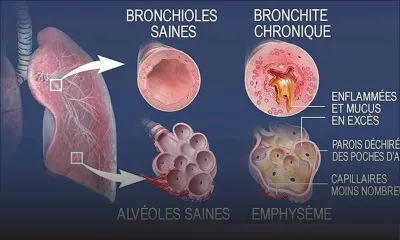 Maladie saisonnière : hausse des cas de bronchiolite chez les jeunes enfants