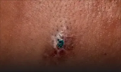 Un mois après une intervention chirurgicale, son calvaire continue