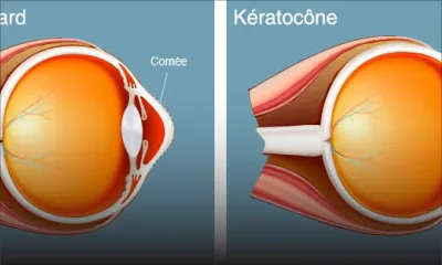 Greffe de la cornée à Apollo Bramwell: Shamima recouvre la vue après 17 ans
