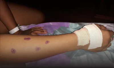 Rose-Hill : une collégienne blessée après que la vitre d’un bus a volé en éclats ; les travaux du Metro Express montrés du doigt