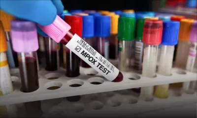 Mpox : deux cas suspects à Maurice, un patient activement recherché