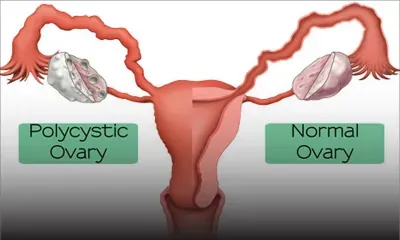Polycystic Ovary Syndrome : Complicated Medical Condition but Can Be Treated