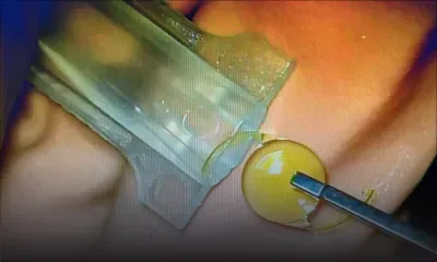 Les lentilles multifocales PanOptix pliables