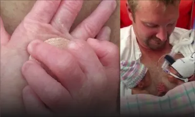 Émouvante histoire de jumeaux prématurés et inséparables