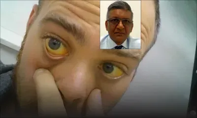 Dr Farouk Bholah : «La jaunisse obstructive est en hausse à Maurice»