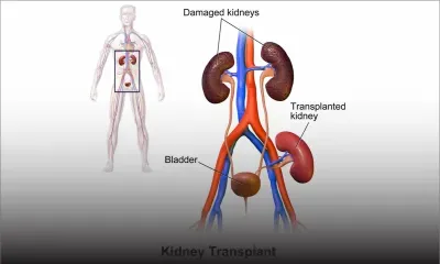 Transplantation rénale : les patients attendent depuis un an