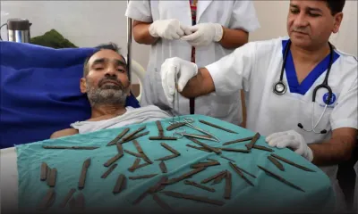 Inde : un homme se fait opérer pour enlever 40 couteaux de son estomac