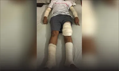 Attaquée il y a un mois et demi : la victime des deux rottweilers devra vivre avec cinq greffes 