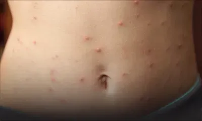 La rougeole toujours en hausse : 76 nouveaux cas enregistrés