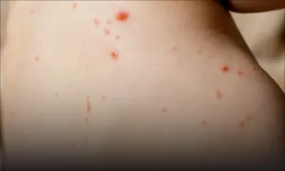 Santé publique : les adultes invités à se faire vacciner contre la rougeole