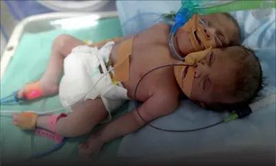 Un bébé né avec deux têtes