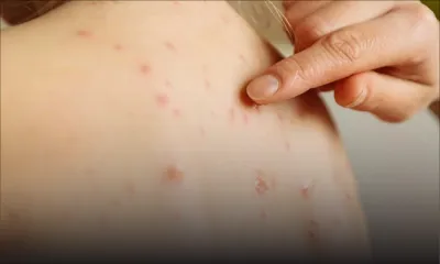 Épidémie de rougeole : décès de trois personnes infectées par cette maladie