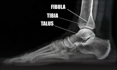 Elle a eu le tibia écrasé dans un accident de la route : les difficultés de Yasmine pour obtenir une pension d’invalidité 