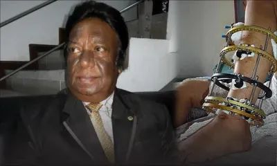 Découverte du Dr Indraduth Chunnoo: une armature métallique pour traiter les fractures